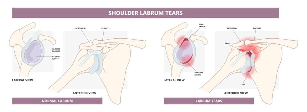 shoulder labrum tears