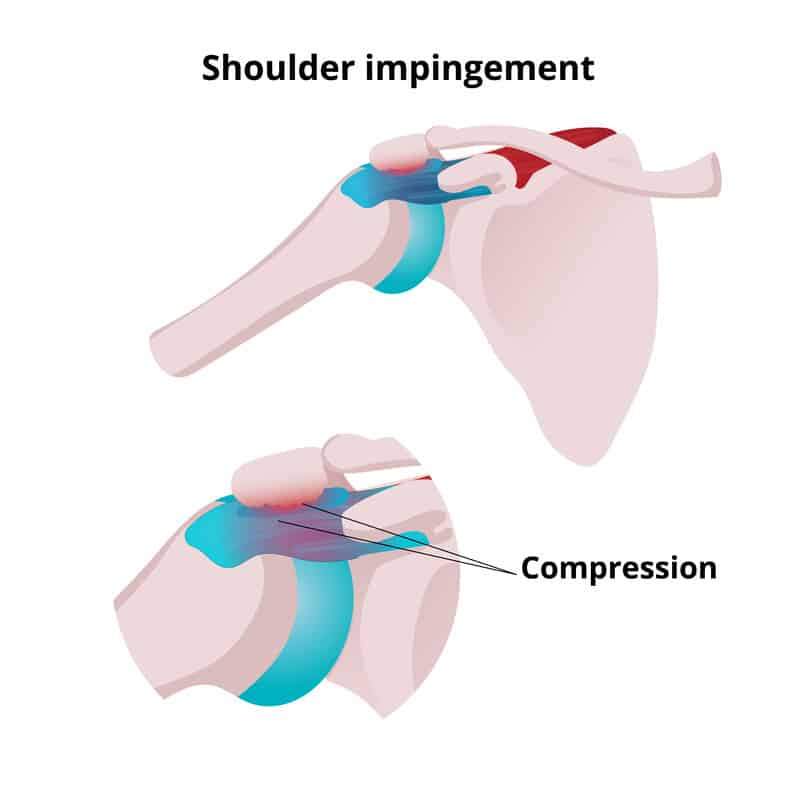 Shoulder Impingement and compression