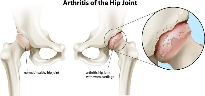 Treatment of Osteoarthritic Change in the Hip―Joint Preservation or Joint Replacement?（ハードカバー） Treatment of Osteoarthritic Change in the Hip―Joint