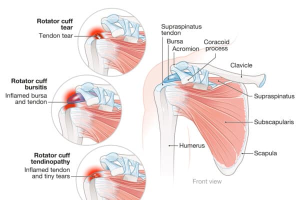 rotator cuff disease