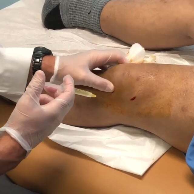 Knee injections