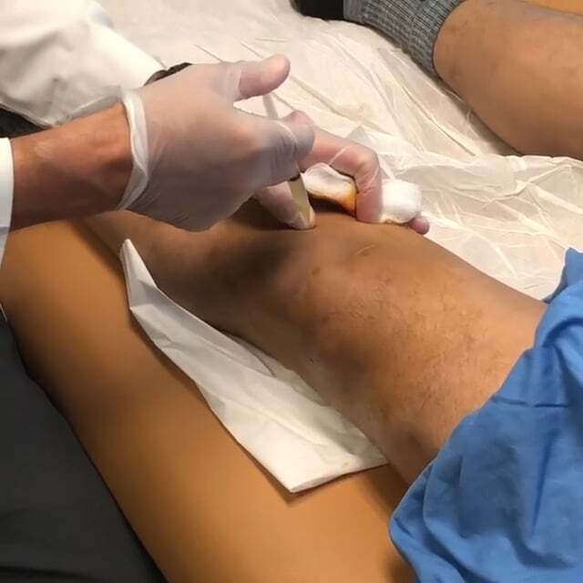 Meniscus injections