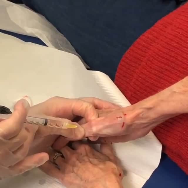 Thumb Injections