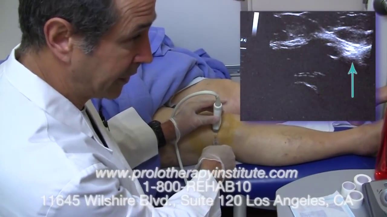 Bone Marrow Stem Cell Treatments for Knee Osteoarthritis