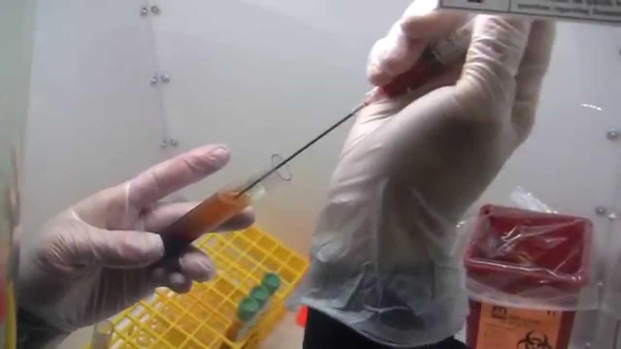 Bone Marrow aspirated stem cells injected into the shoulder