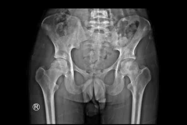 FemoroAcetabular Impingement