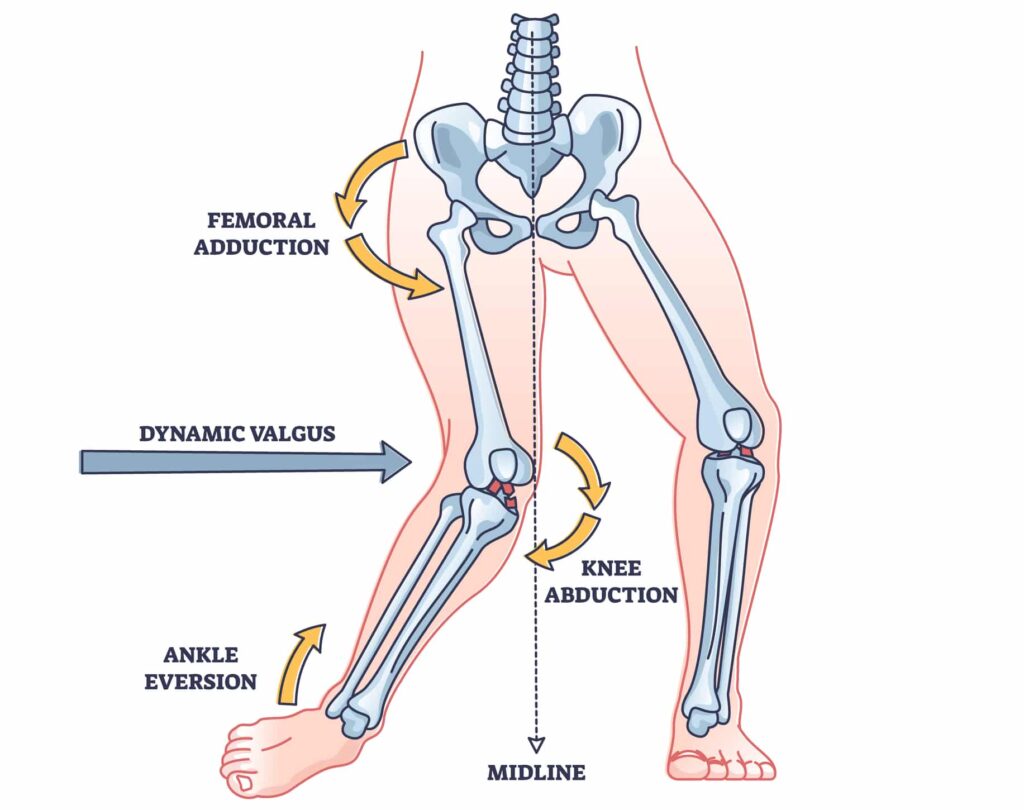 How an ACL tear occurs