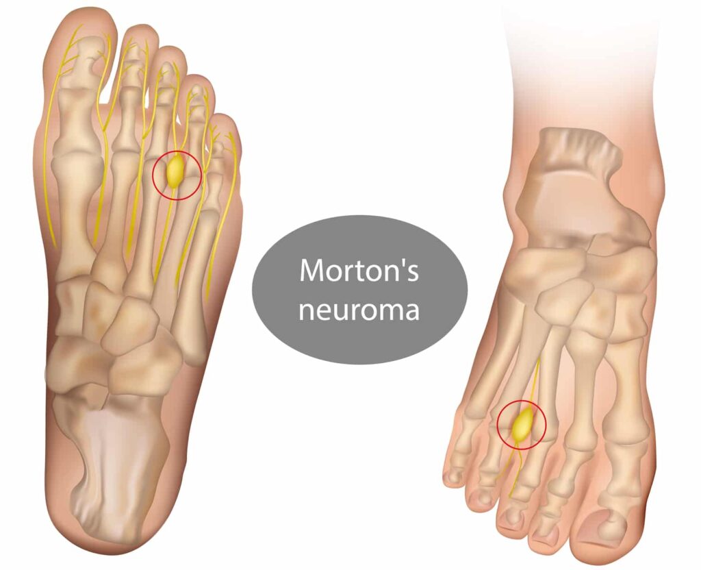 Morton neuroma, metatarsalgia, Intermetatarsal neuroma Morton neuroma, metatarsalgia, Intermetatarsal neuroma