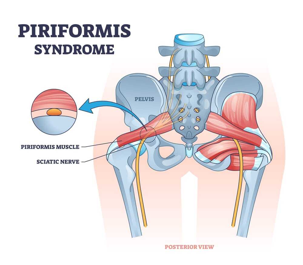 Piriformis syndrome and sciatic nerve compression