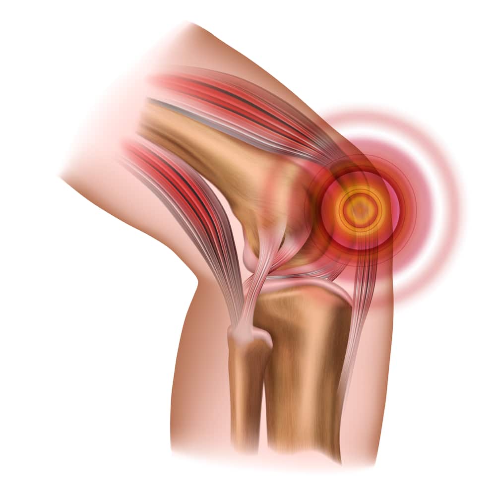 Patella tendinopathy Patella tendinopathy