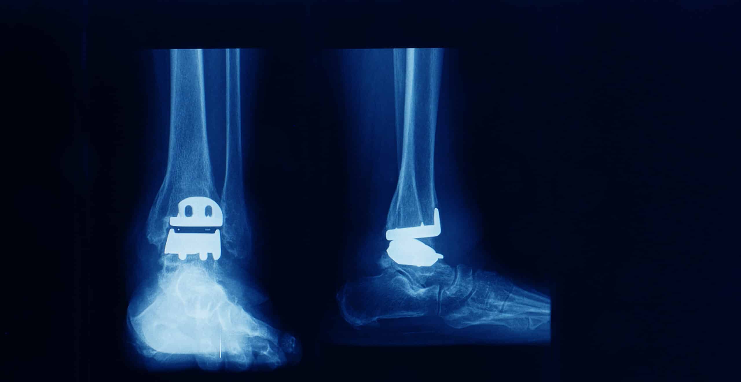 ankle replacement 