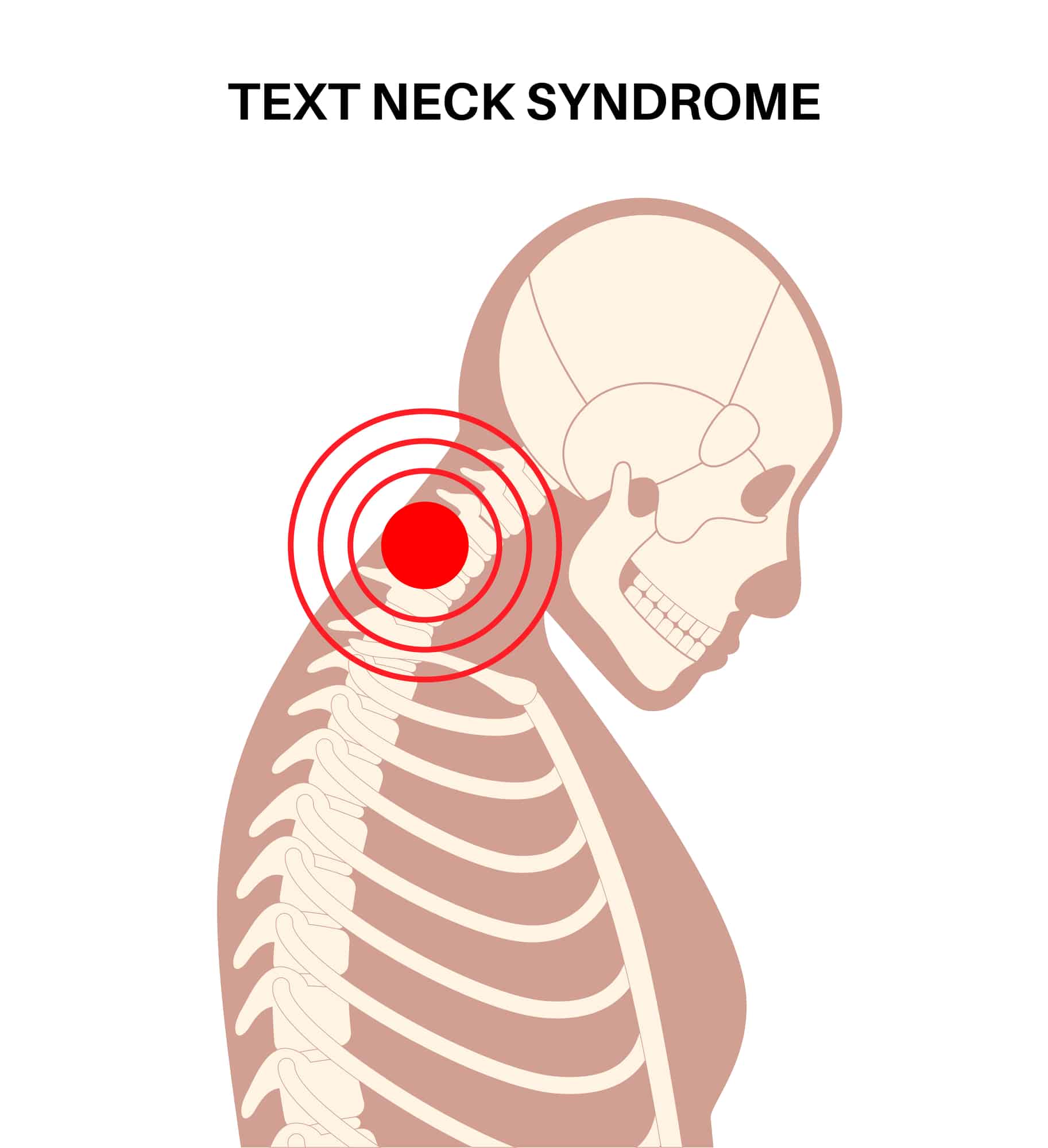 Medical illustration showing a deformity of the neck vertebrae.