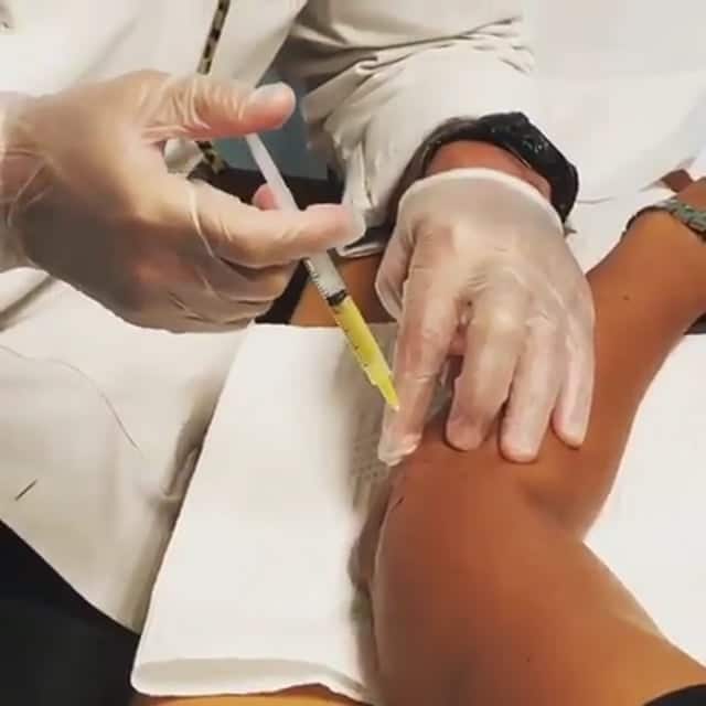 PRP Elbow Injections