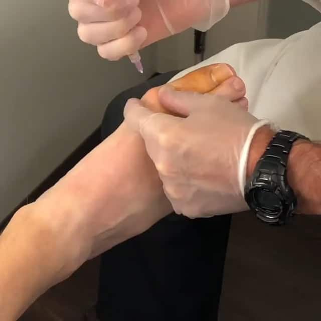 Toe Injections