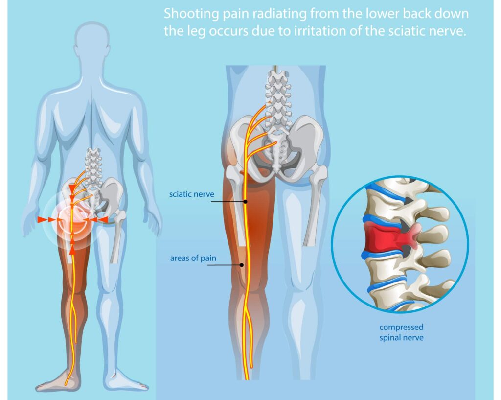 Understanding Sciatica and Its Symptoms Understanding Sciatica and Its Symptoms