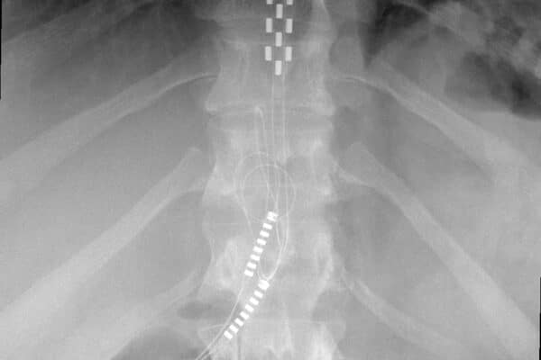 Anterior thoracic SCS11