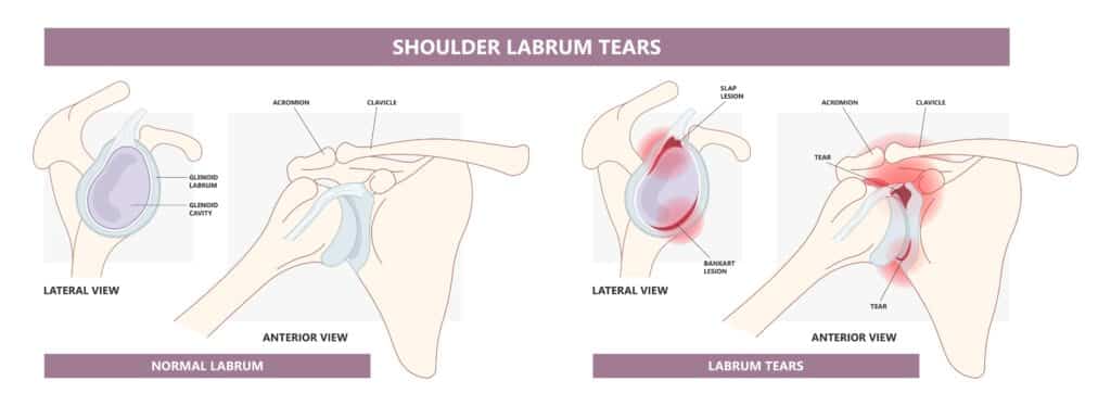 slap tear surgery failure