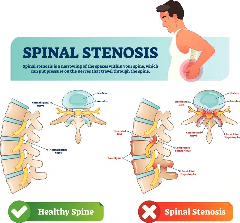 Lumbar Spinal Stenosis Joint Rehab And Sports Medical Center   Spinal Stenosis Injections1 