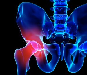Hip replacement scaled