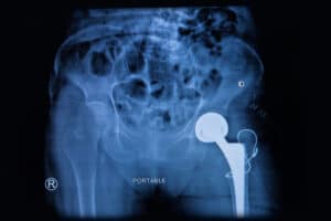 hip replacement 1