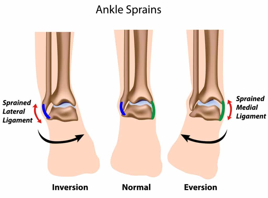Chronic Ankle Instability Chronic Ankle Instability