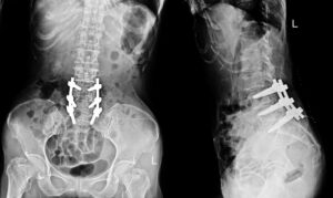 X-ray image showing metal screws implanted inside the body.