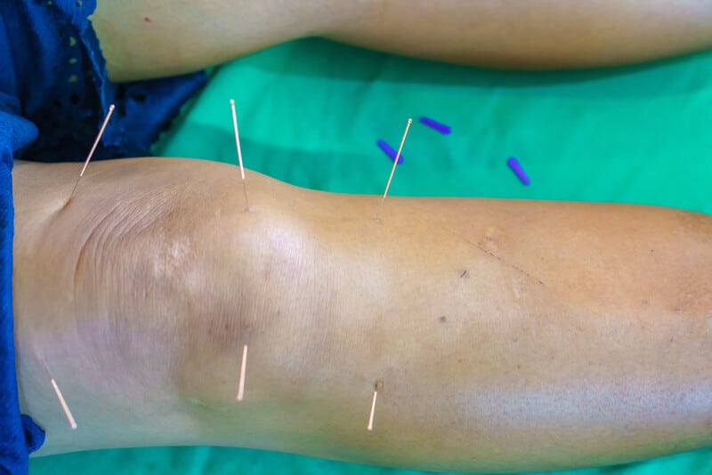 Acupuncture Points For Knee Pain Pdf