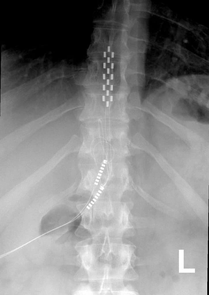 Spinal Cord Stimulation For Failed Back Surgery Patients