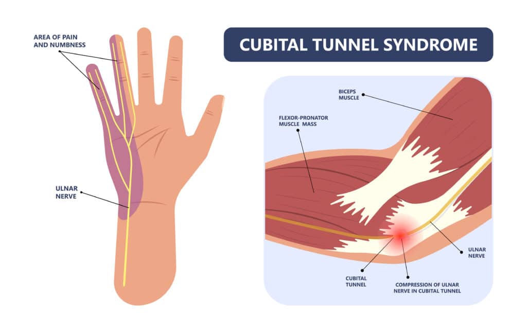 Cubital Tunnel Syndrome Treatment in Raleigh by Dr. Erickson