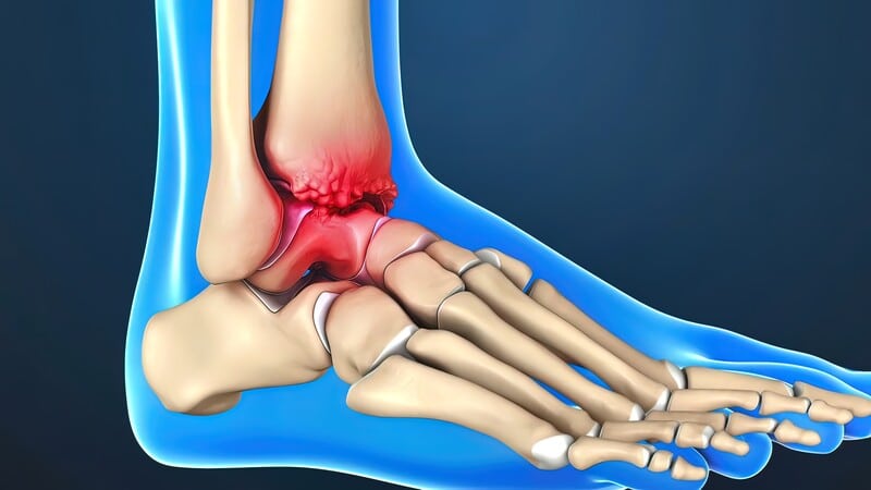 Ankle Replacement Surgery: Use, Procedure, Risks