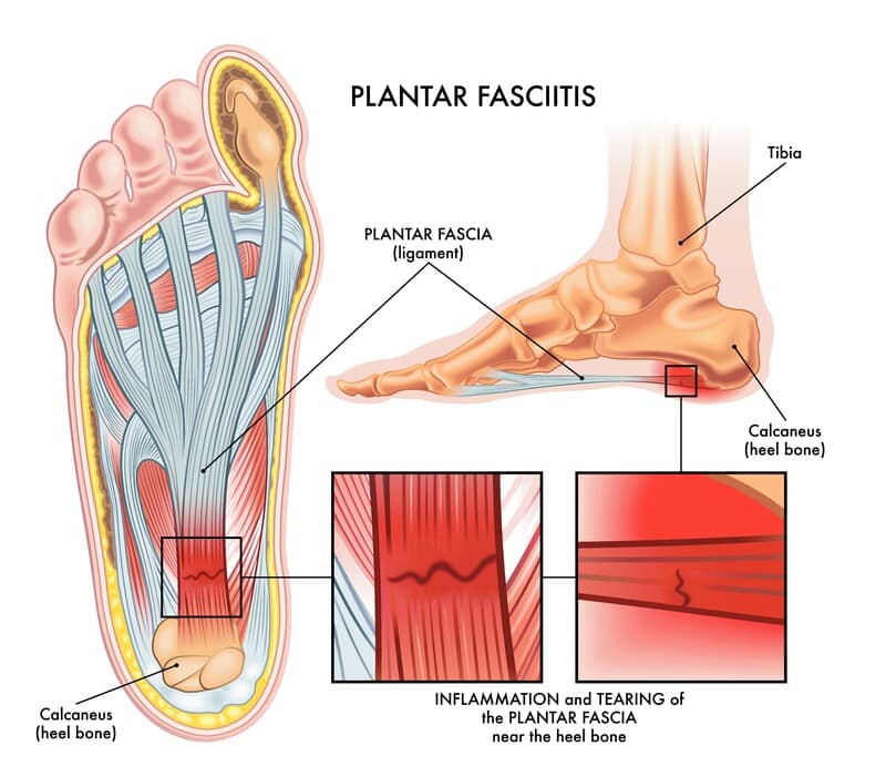Platelet rich plasma (PRP) injections for plantarfasciitis - Ultrasound  Guided Injections