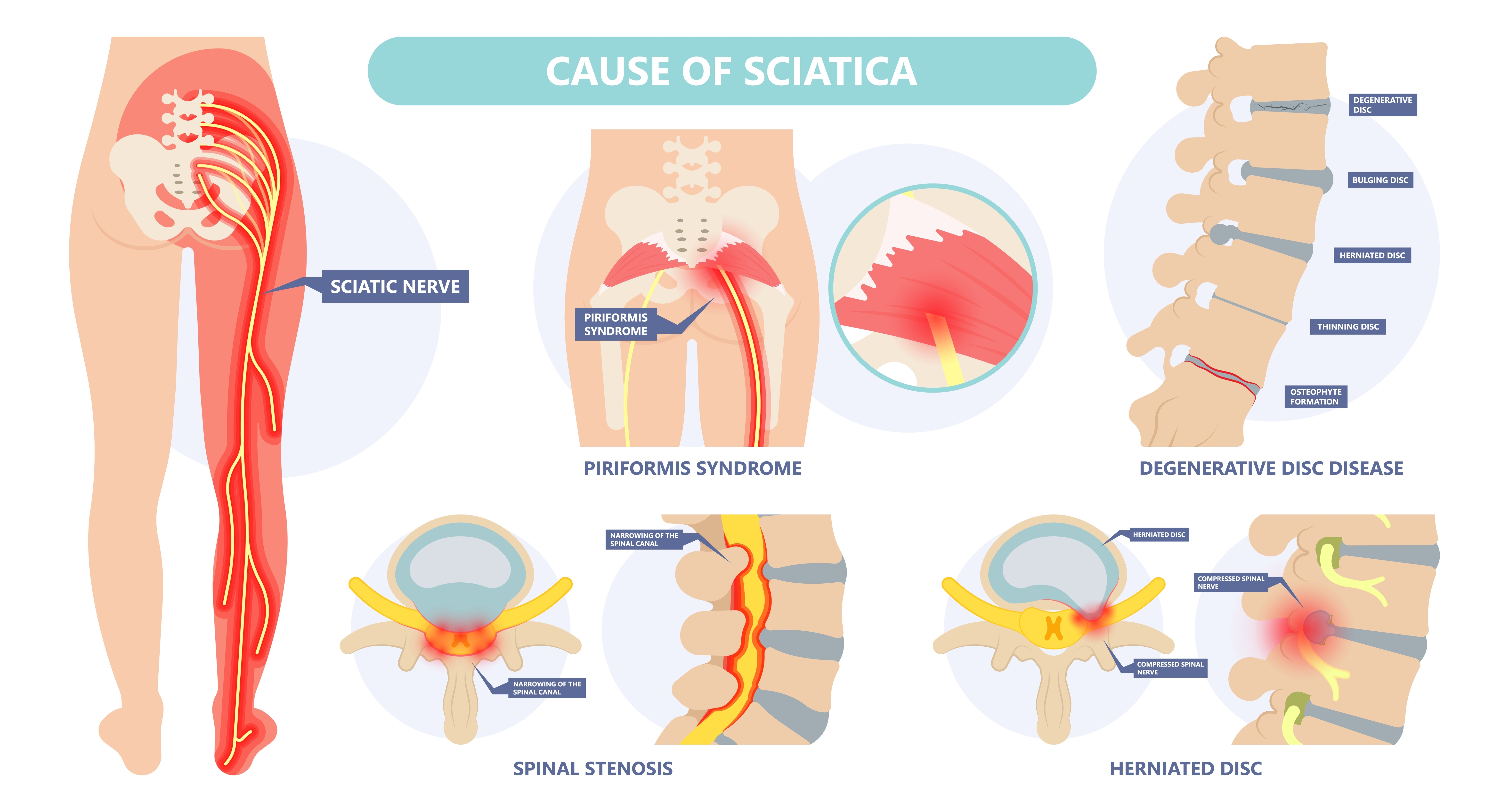 Sciatica: Causes, conservative care, surgery, and injection