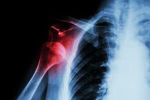 shoulder dislocation1