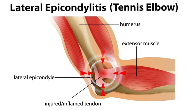 10 Valuable Pros & Cons Of Using K Tape For Tennis Elbow Pain