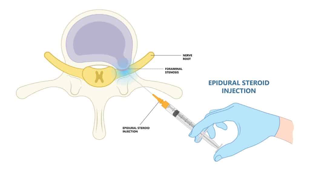 Epidural Steroid Injections Can Help Relieve Your Pain After a Herniated  Disc.: Advanced Pain Management Center: Interventional Pain Management  Physician