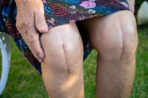 woman knee replacement1 1