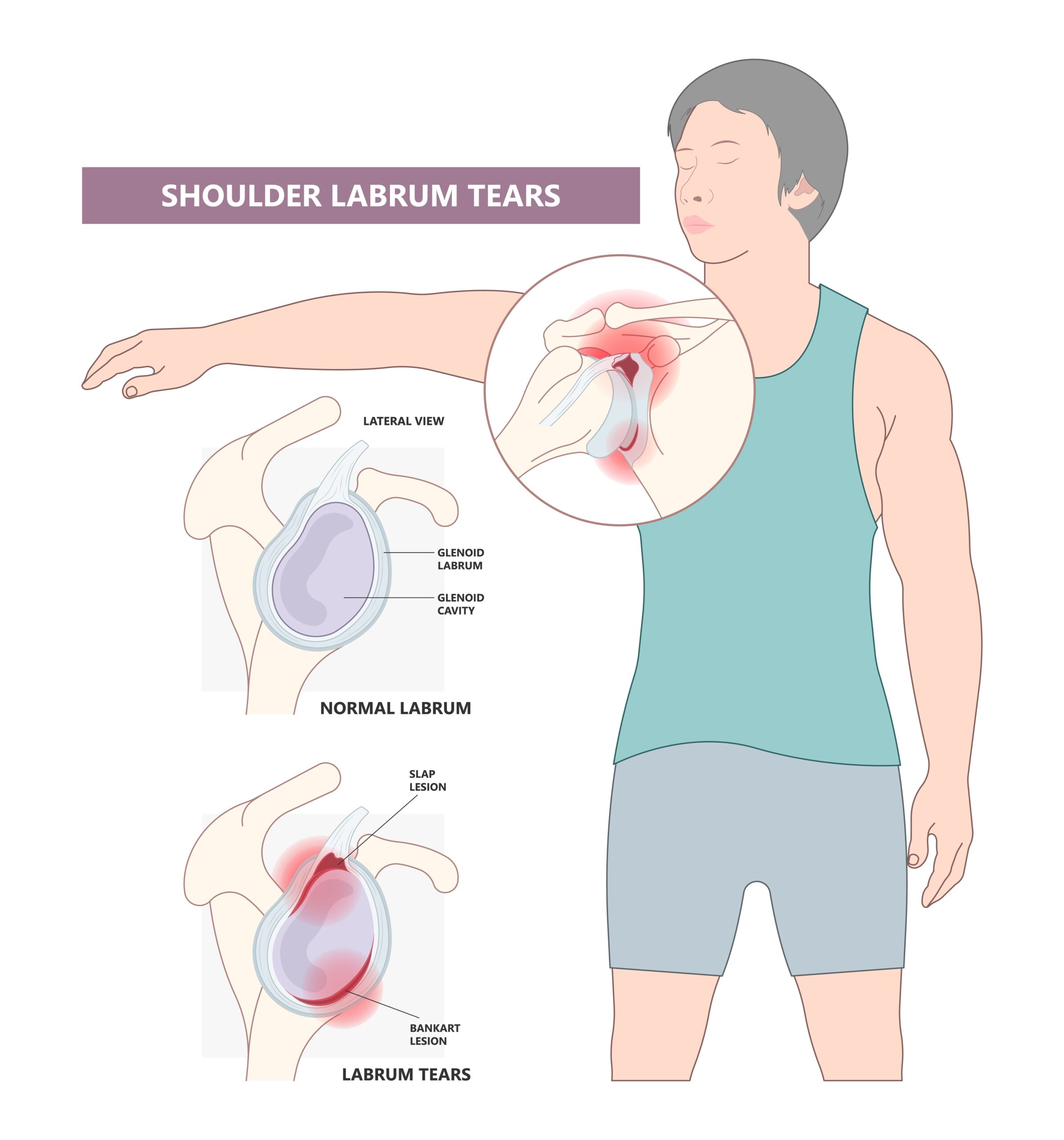 slap tear surgery failure