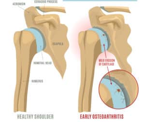 shoulder arthritis scaled e1686680442334