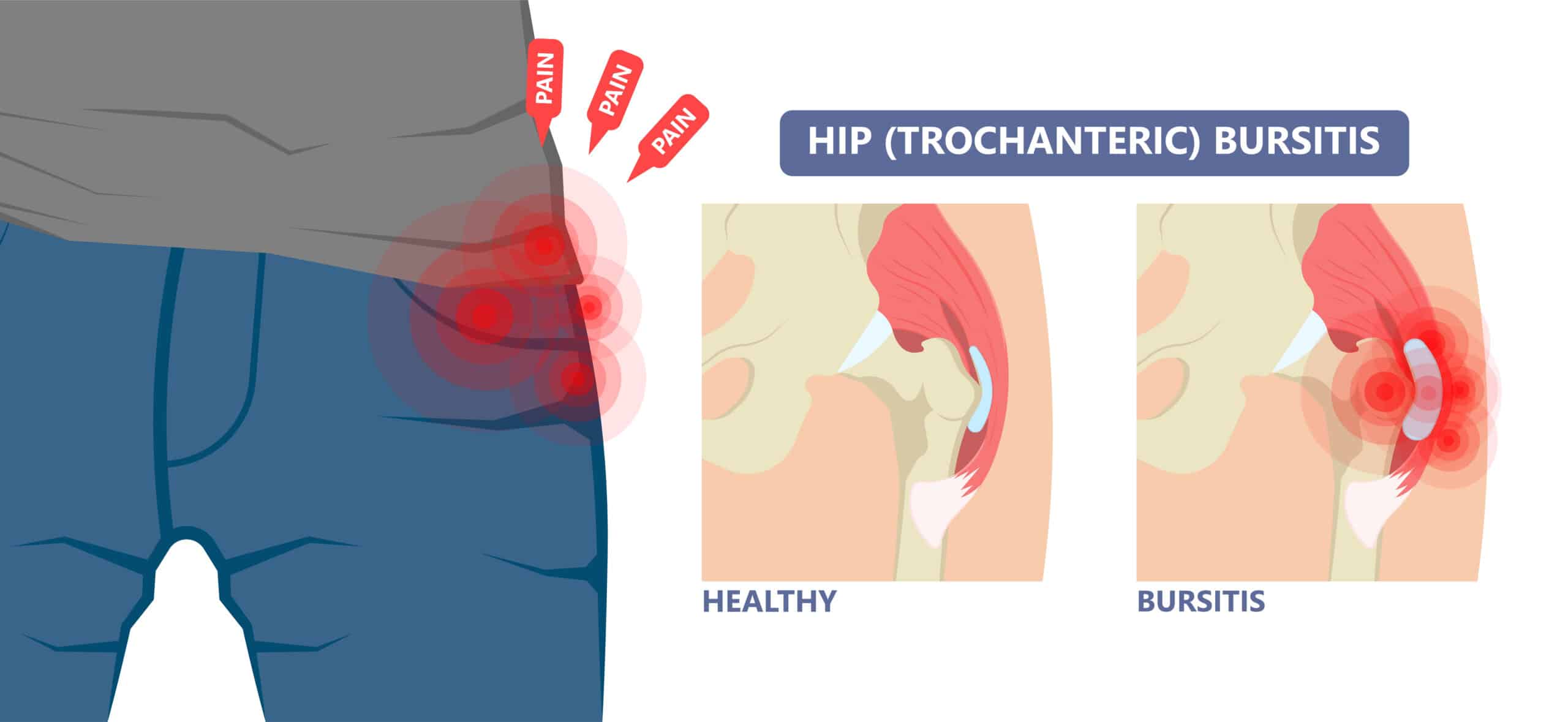 Greater trochanteric pain syndrome - Joint Rehab and Sports Medical Center