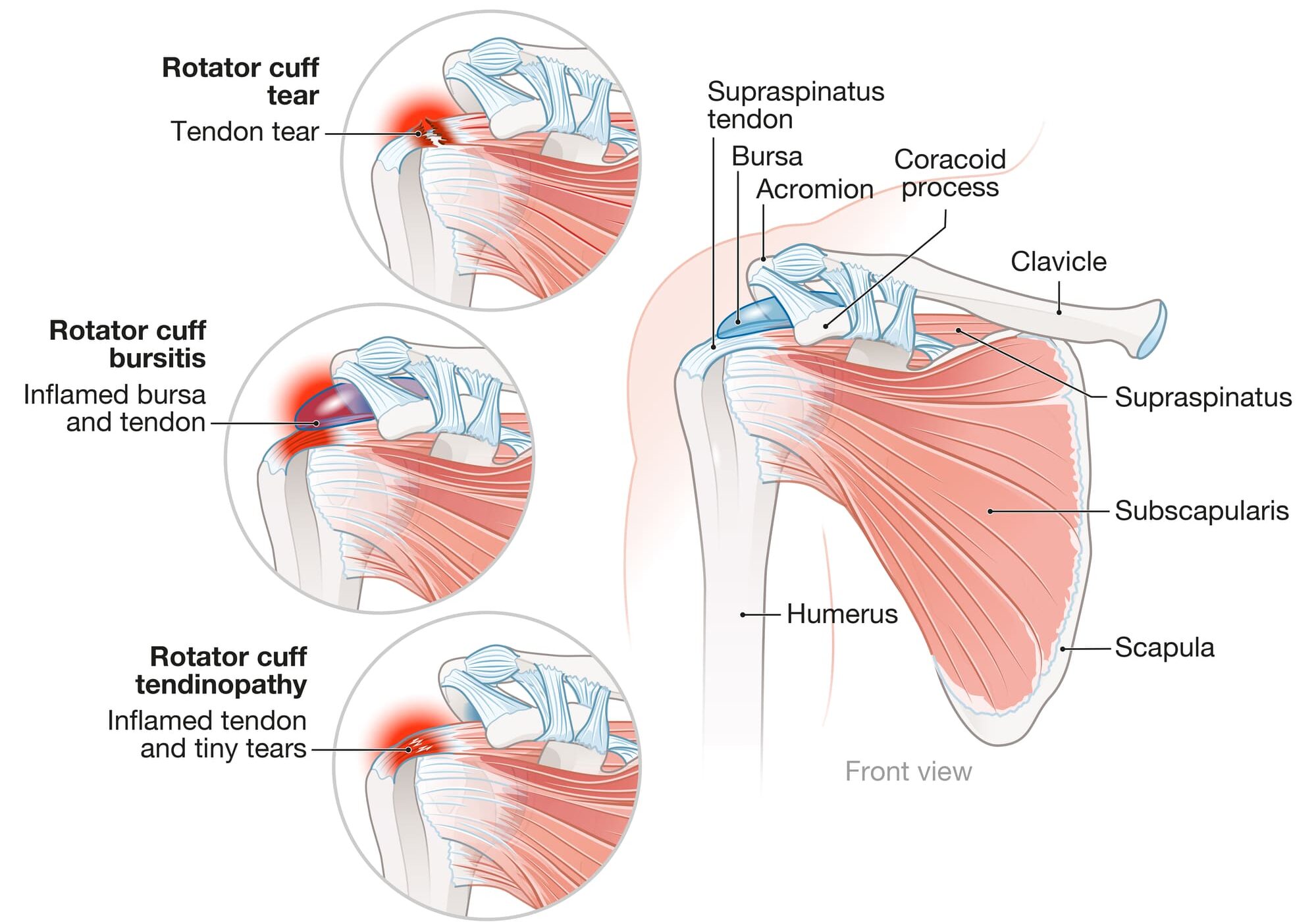 Rotator cuff tear conservative treatments and injections