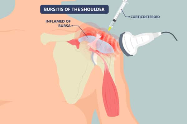 shoulder cortisone scaled
