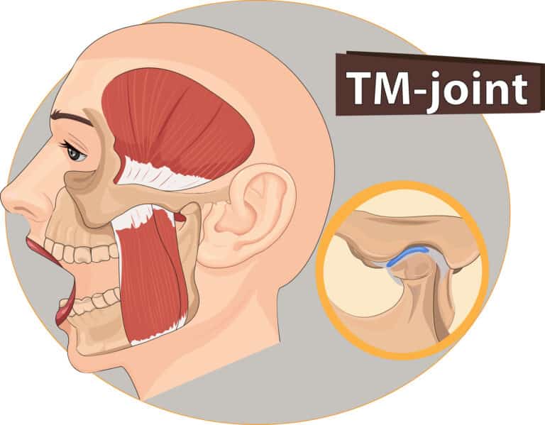 Medical illustration of the temporomandibular (TMJ) joint.