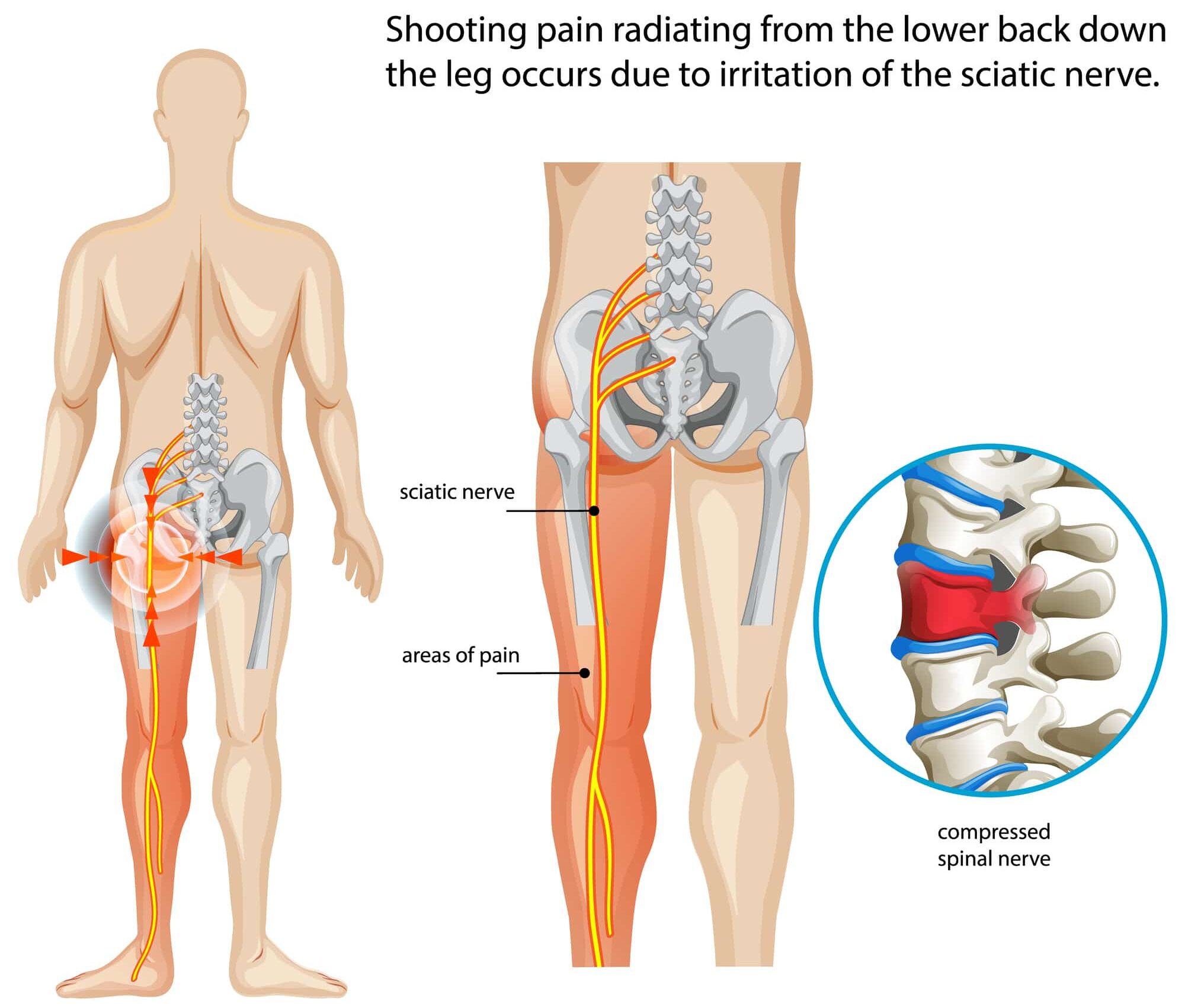 Illustration explaining sciatica and nerve pain, highlighting the path of the sciatic nerve and common symptoms such as radiating pain, numbness, and muscle weakness.