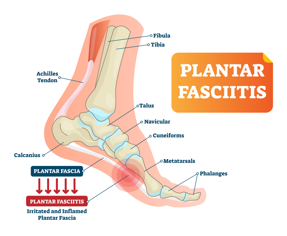 Plantar Fasciitis injection treatment in Los Angeles