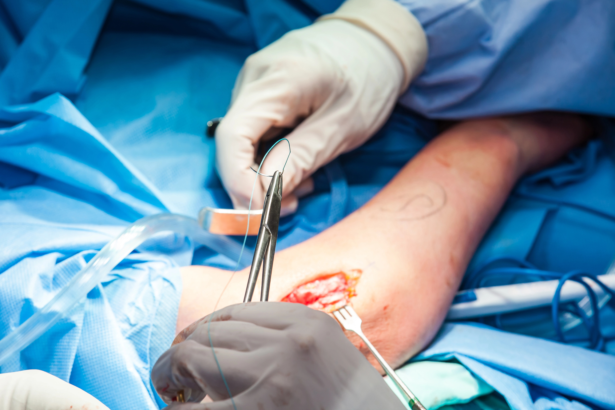 elbow surgery elbow surgery