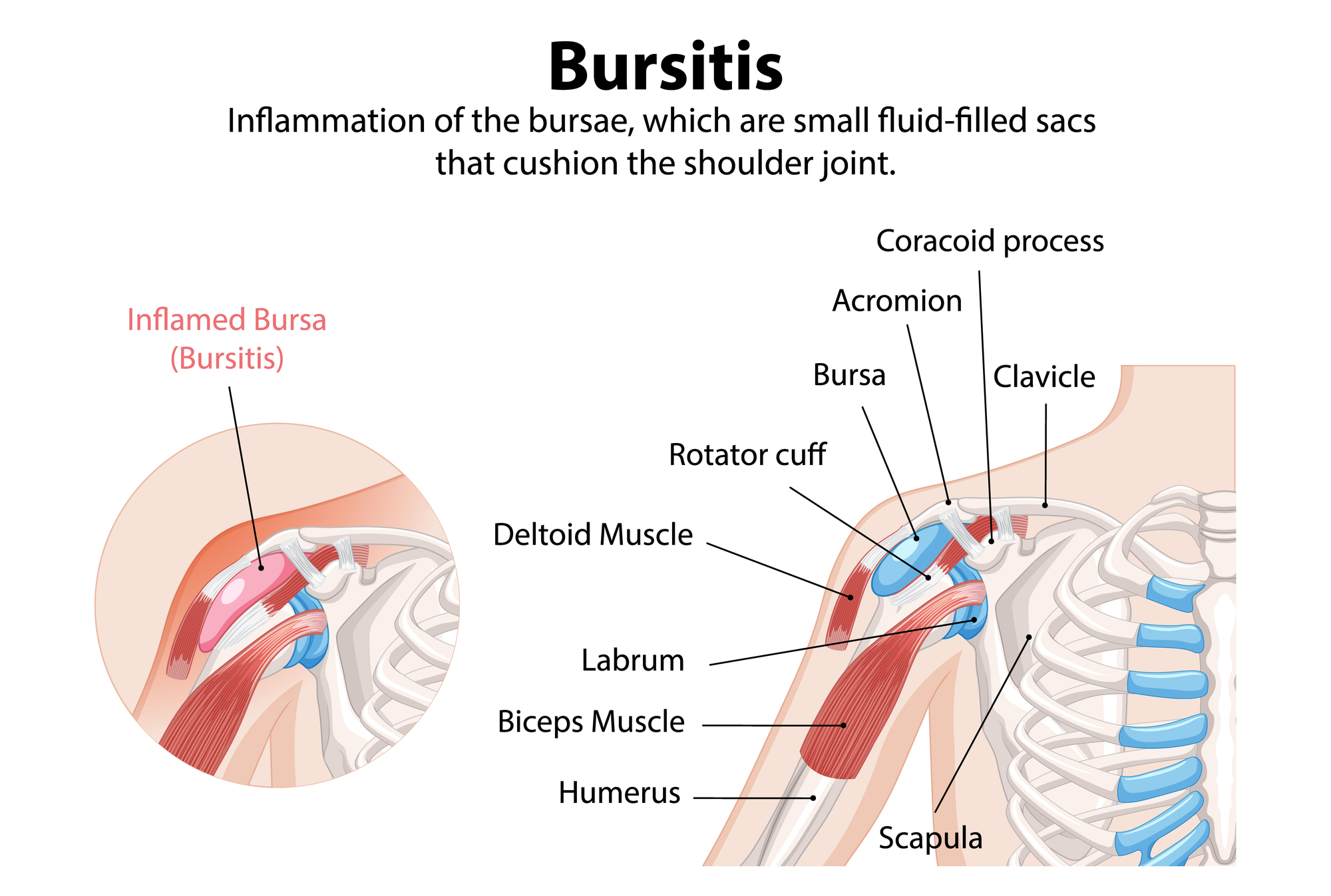 Bursitis in the Shoulder Joint