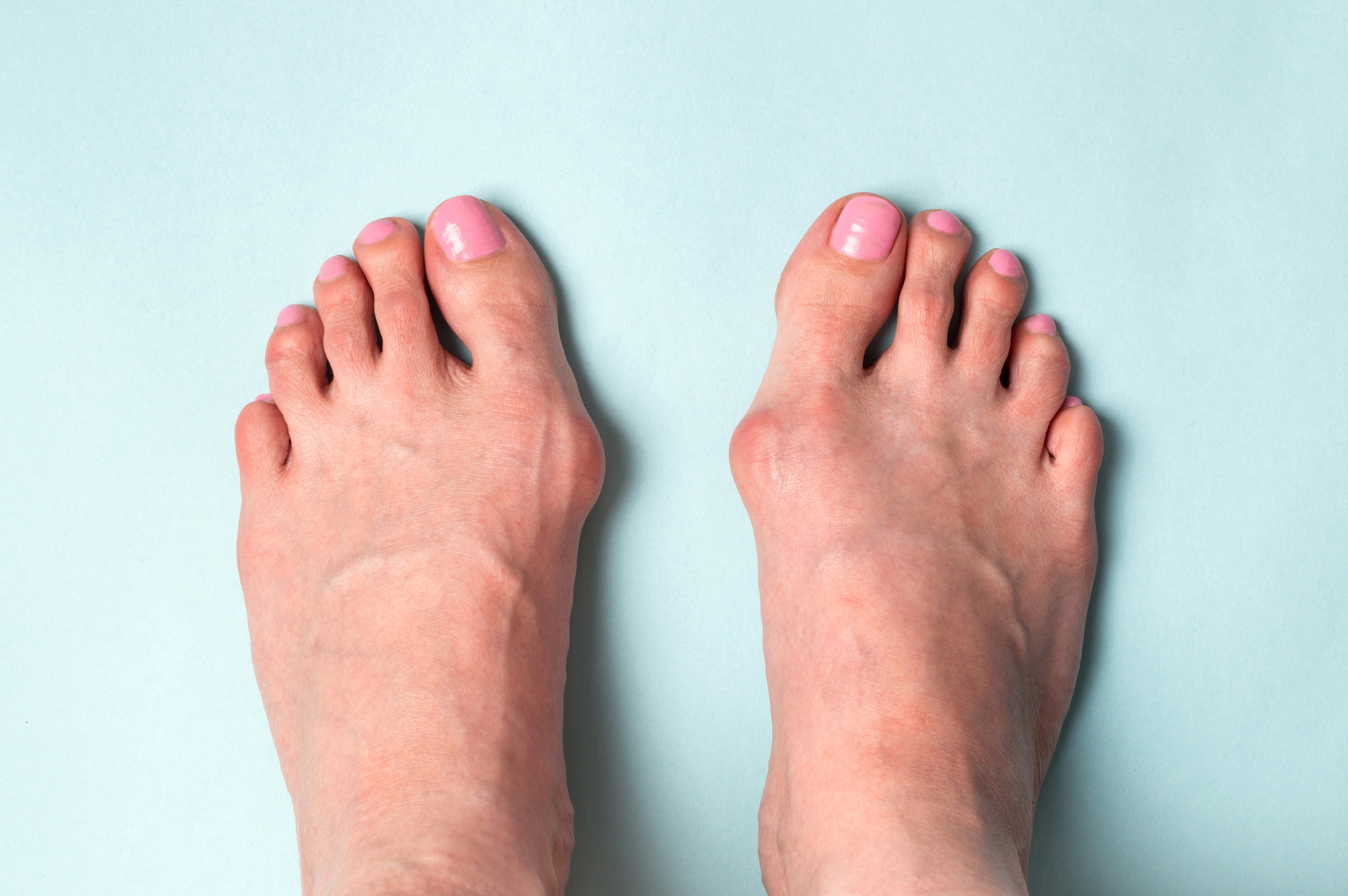 bunions ()